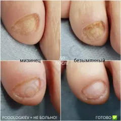 Nail fungus 1