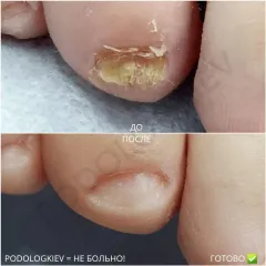 Nail fungus 3