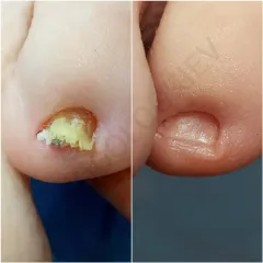Nail fungus 4
