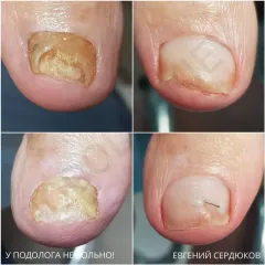 Nail fungus 5