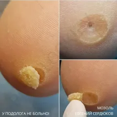 Mozoli_na_nogah_-12