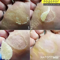 Mozoli_na_nogah_-3