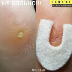 Mozoli_na_nogah_-4