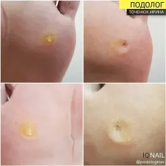 Mozoli_na_nogah_-5