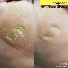 Mozoli_na_nogah_-6