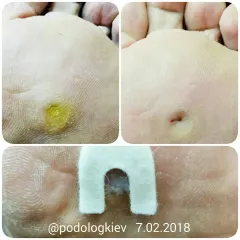 Calluses 11