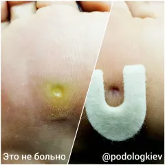 Calluses 2