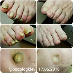 Calluses 8