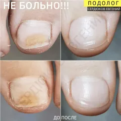 Onycholysis 1