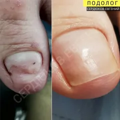 Onycholysis 11