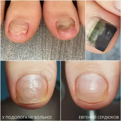 Onycholysis 14