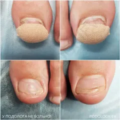 Onycholysis 18