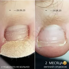 Onycholysis 20