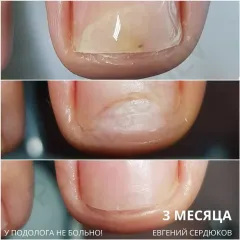 Onycholysis 21