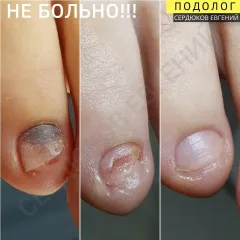 Onycholysis 24