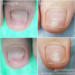 Onycholysis 26
