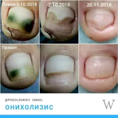 Onycholysis 28