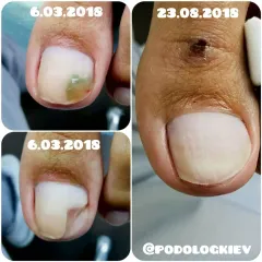 Onycholysis 29