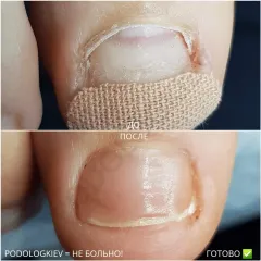 Onycholysis 7