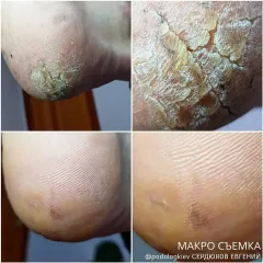 Pedykyur_Keratoz_na_stopah-2