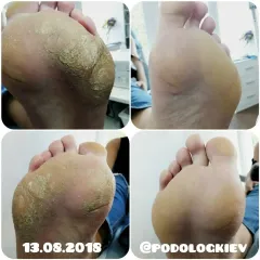 Pedykyur_Keratoz_na_stopah-7