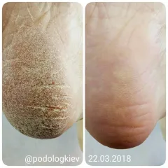 Pedykyur_Keratoz_na_stopah-8