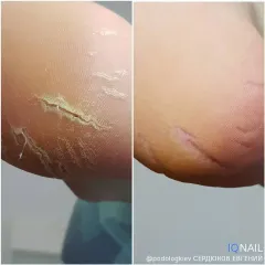 Pedicure 5