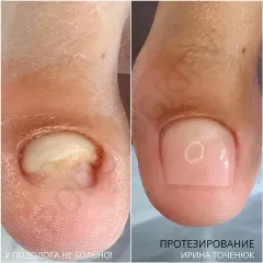 Protezuvannya_nigtiv-2