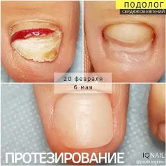 Protezuvannya_nigtiv-4