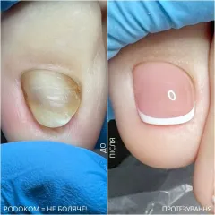 Nail prosthetics 6