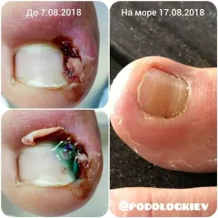 Wrastający paznokieć 10