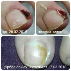 Wrastający paznokieć 11