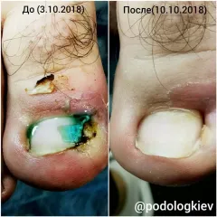 Wrastający paznokieć 7