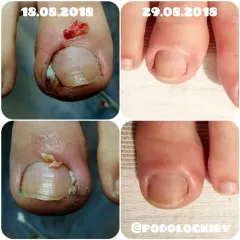 Wrastający paznokieć 9
