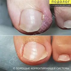 Врослий ніготь 4