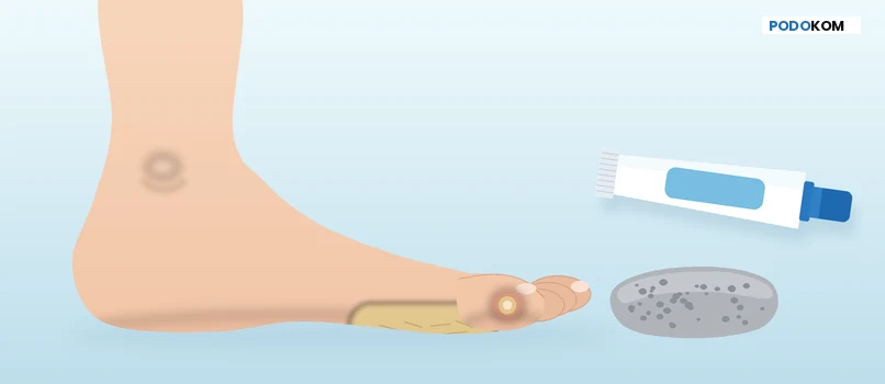 A bare foot from the side with a broad callus on the ball of the foot and a small round corn on the little toe, next to a pumice stone and a tube of cream, Podokom article