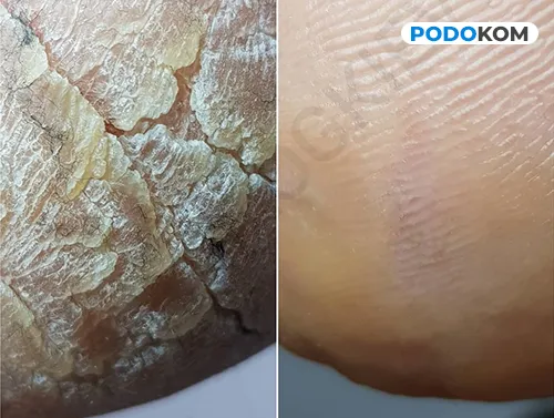 Профілактика та лікування гіперкератозу стопи