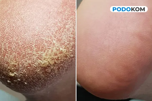 Секрети здорової шкіри без гіперкератозу