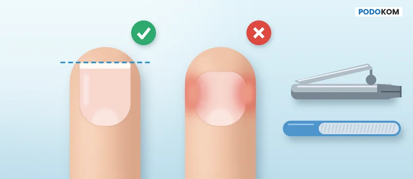 A toenail cut straight across and one with rounded corners, Podokom article