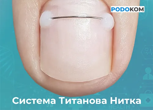 Корекційна система Титанова нитка