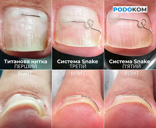 Корекційна система Snake