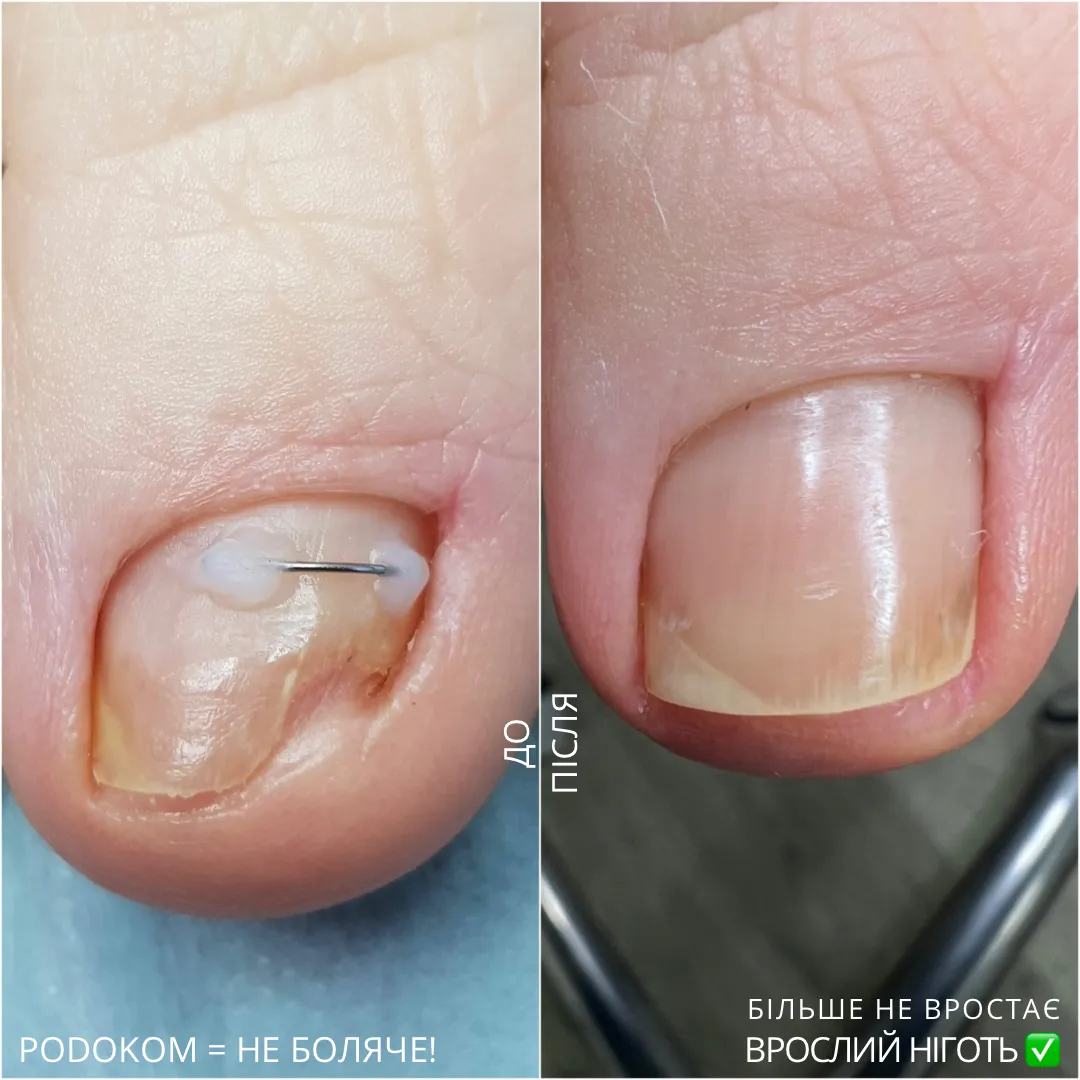 Nail correction systems. Recovery over 12 months