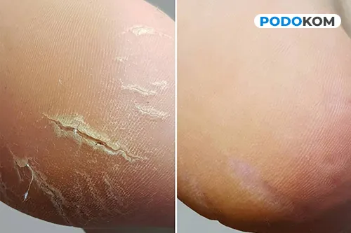 Майстер виконує медичний педикюр акуратно