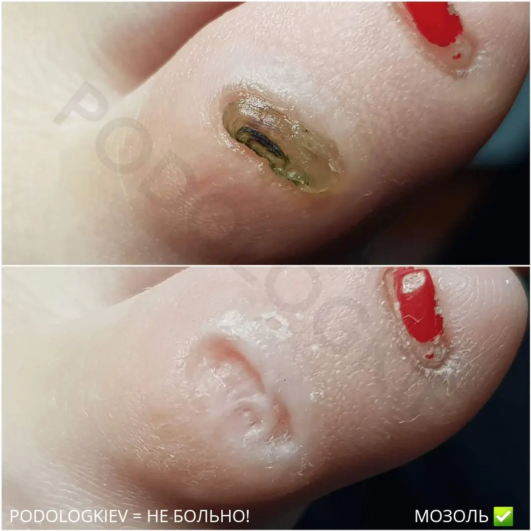 Callus removal in a single visit