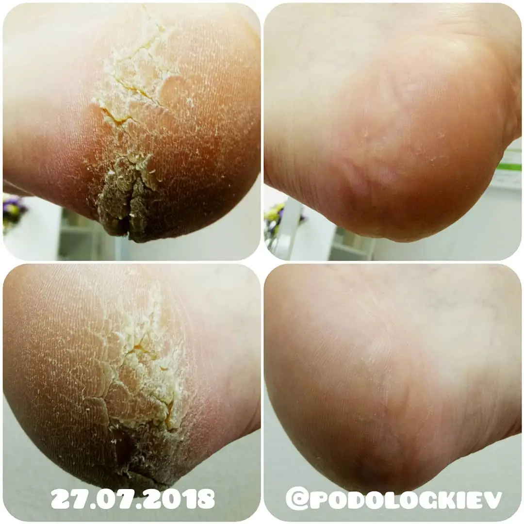 Treatment of hyperkeratosis on the heels at Podokom.com