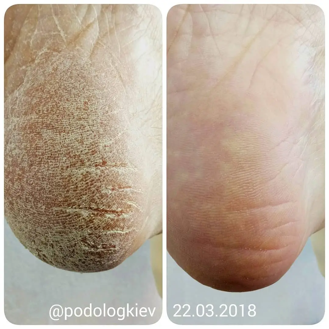 Pedicure. Keratosis on the feet.