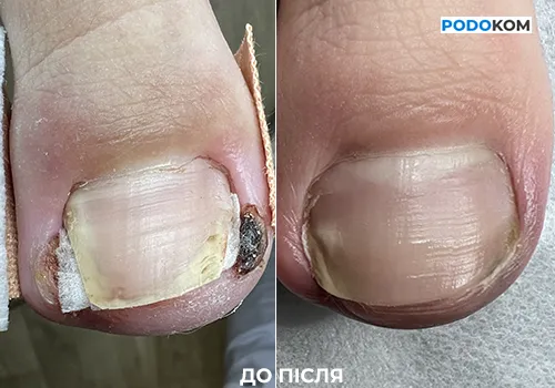 Врослий ніготь До Після