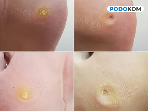 Професійне видалення мозолів у Києві в Podokom