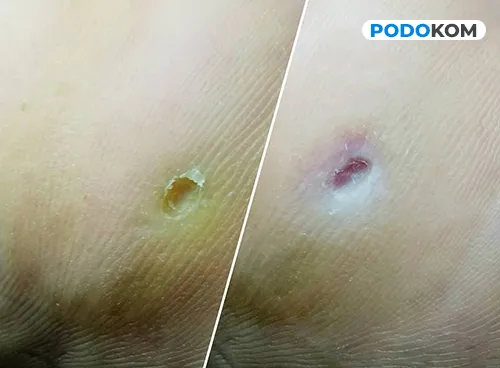 Процедура видалення мозолів у Києві без болю