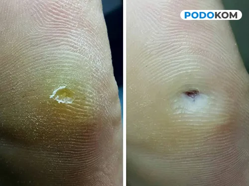 Здорові ноги після видалення мозолів у Києві